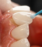 a-tooth-with-a-blue-toothbrush-in-it.jpg a tooth with a blue toothbrush in it